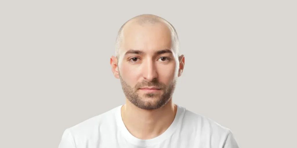 Man with shaved head showcasing results of Hair System for Bald Men in Birmingham.