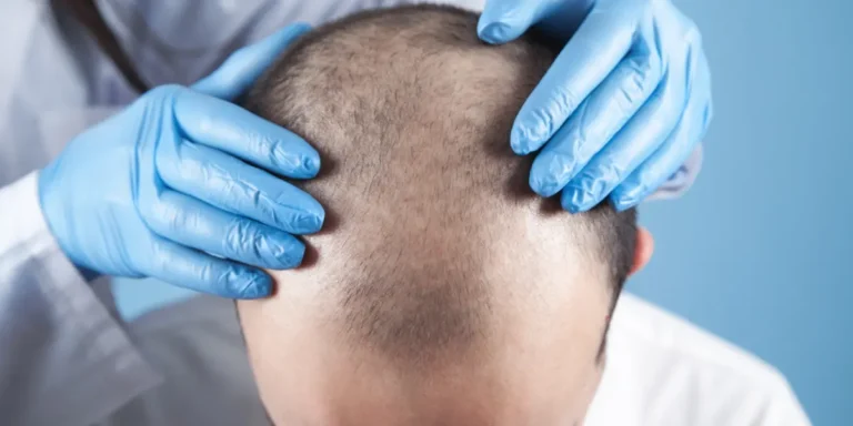 Doctor examining scalp for Hair System for Bald Men in Birmingham treatment evaluation