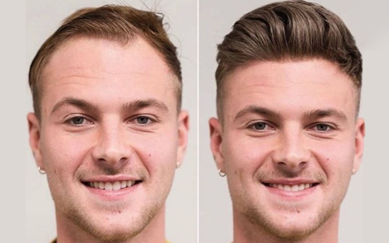 Why choose our hair (1) Hair system in Birmingham offering non-surgical hair restoration with a natural, fuller look for men experiencing hair loss.